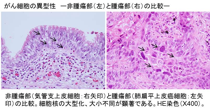 横浜市大医学部病態病理学のホームページメニューがん細胞の形態異状メニュー
