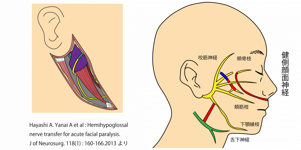 健側顔面神経 林礼人 Hayashi A. Yanai A et al:Hemihypoglossal nerve transfer for acute facial paralysis.