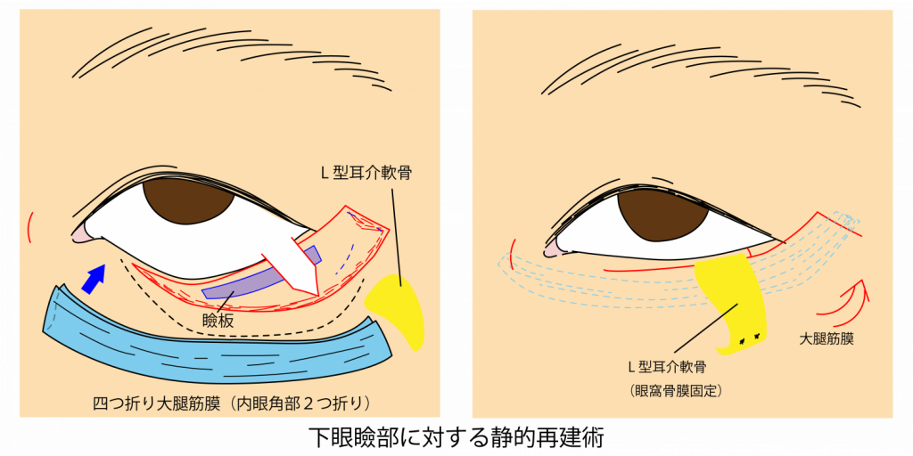 下眼瞼部に対する静的再建術